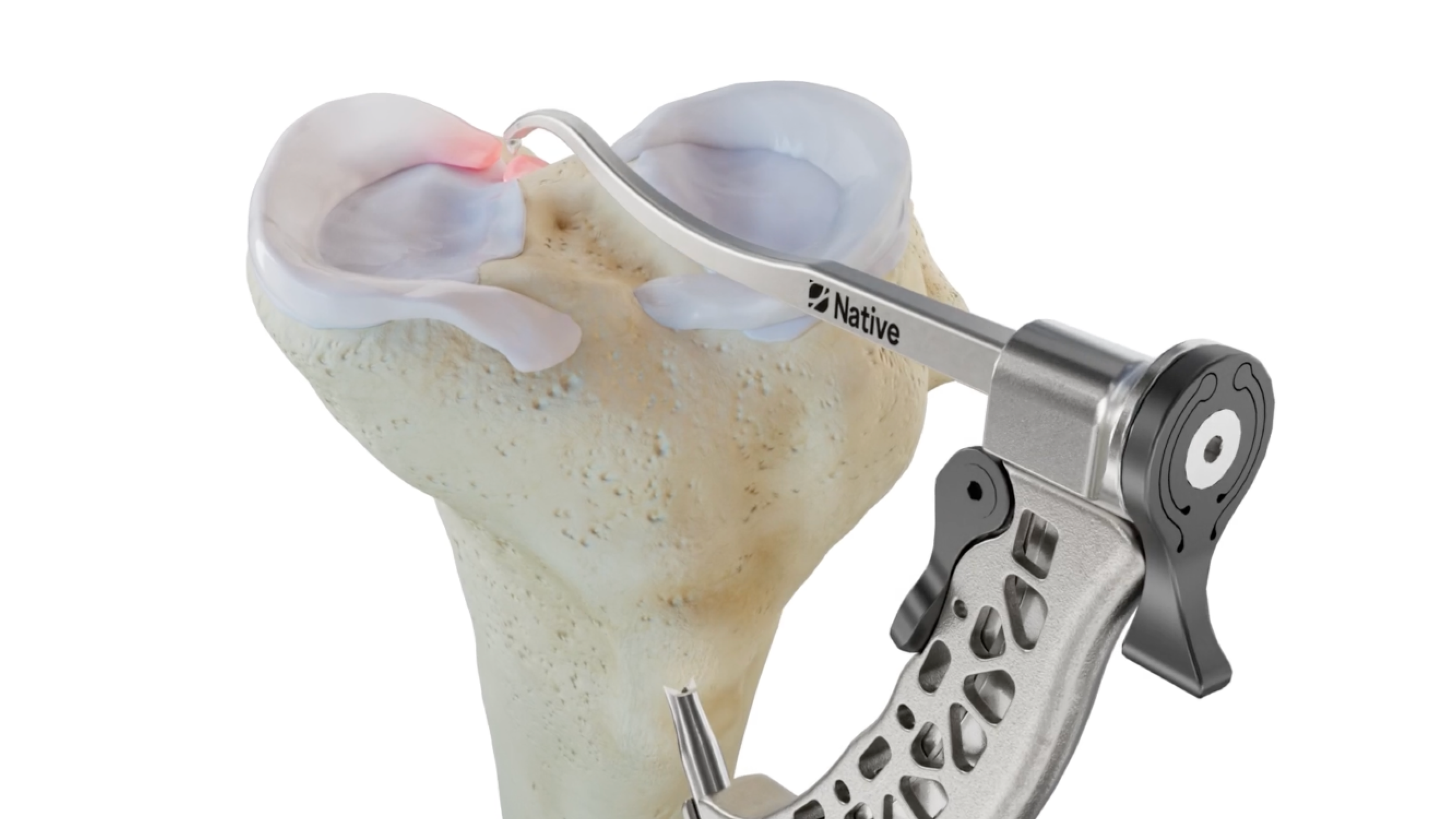 Surgical Technique — Native Orthopaedics